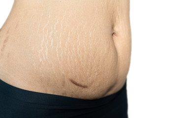 Fat belly scratch mark pregnancy female Skin surgical operation remove appendix scar