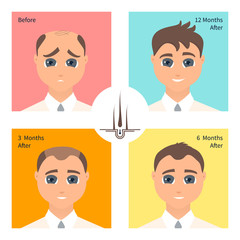 Hair transplantation surgery post operative result infographics. Man patient before and after procedure. Male hair loss treatment with FUT, FUE method. Alopecia medical design poster.