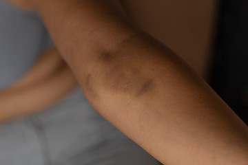 Bruises on the arm of a women - Problem skin on the arm.