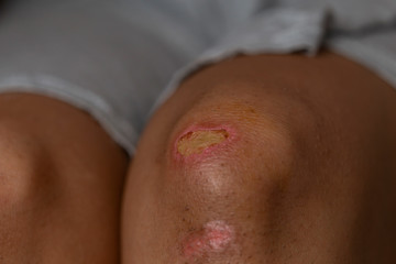Women injury - painful knee wound accident - Bruised wound injury on woman knee - Medical and health conditions