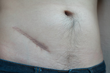 scar from operation suture,Lesions from appendicitis surgery.