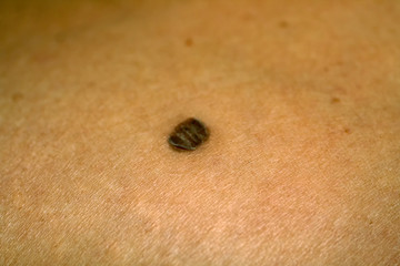 Brown spot. Scaly, flaky. Birthmark on skin.