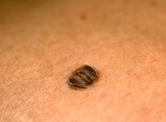 Brown spot. Scaly, flaky. Birthmark on skin.