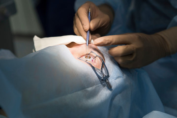 Laser surgery for vision correction