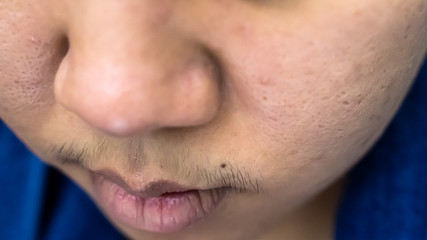 Obraz premium Facial acne is Asian women aged 25-30 and pores wrinkles are allergic to cosmetics.