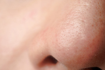 A close up of white head on nose of asian men