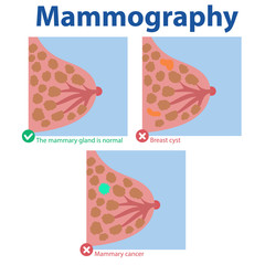 Mammography. The results of the medical examination normal breast, breast cyst, breast cancer. Vector file editable EPS 10
