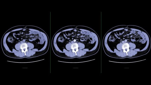 CT whole abdomen Comparison non contrast media, A phase,V phase and with delayed phase Axial view showing enhancement of aorta for diagnosis disease and cancer in abdomen .