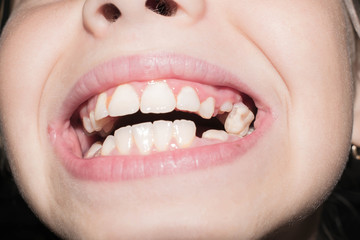 Baby teeth fall out break blacken infected with caries for medicine