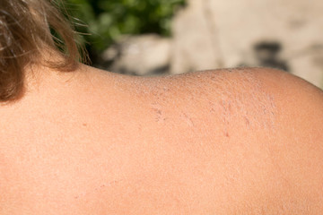 Affected skin of a child's corrosion dry crust flakes for medicine