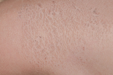 Fototapeta premium Affected skin of a child's corrosion dry crust flakes for medicine