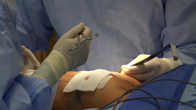 Breast augmentation are plastic surgery terms for the breast-implant and the fat-graft mammoplasty approaches used to increase the size and alter the texture of the breasts of a woman.
