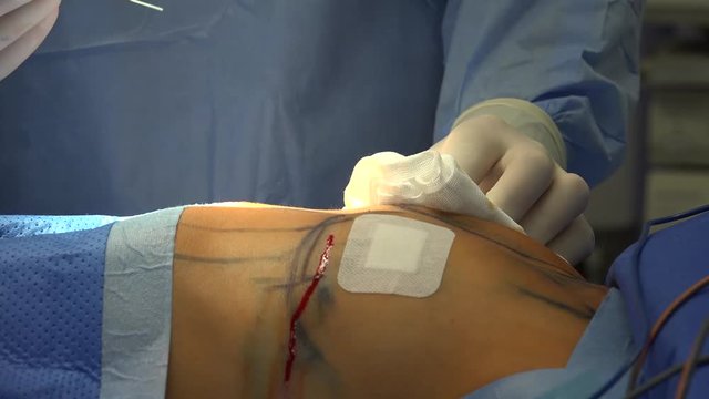 Breast augmentation are plastic surgery terms for the breast-implant and the fat-graft mammoplasty approaches used to increase the size and alter the texture of the breasts of a woman.