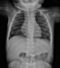 Chest X-ray  image of child