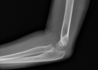  X-ray  human arms broken arm