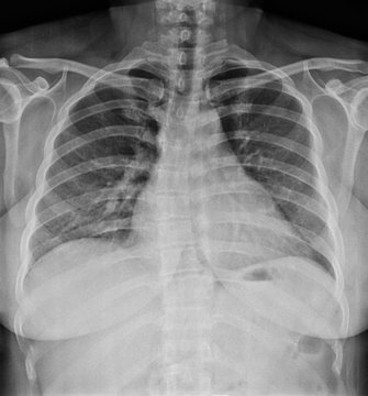 A chest x-ray image for a medical diagnosis.
