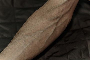 Blood vessels,The veins on arms,Blood vessels on the arms of patients.