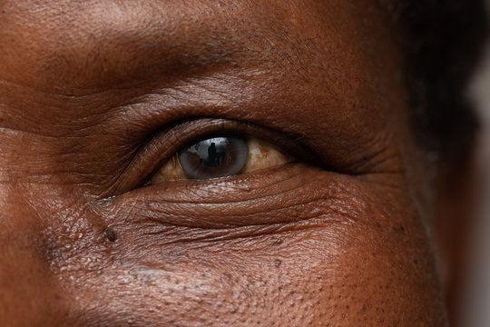 An extreme close-up view on the eye of an African man with a cataract. Elderly man with aging and degeneration of eyesight. Copy-space on the right.