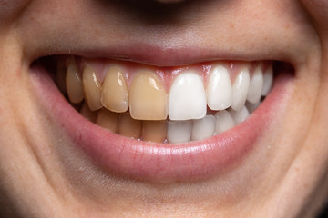 Before and after view of tooth whitening. A young Caucasian girl smiles wide and is seen close up....