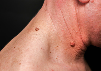 Big birthmark on the man's skin. Medical health photo. Papillomas on the neck. - obrazy, fototapety, plakaty