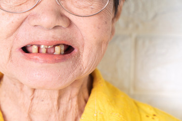 Asian Elderly woman over 70 years old be smile with a few broken teeth here have problem of ability...