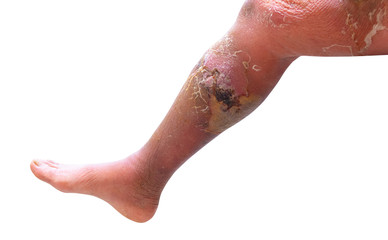 Fototapeta premium Erysipelas bacterial infection Under the skin leg aged people On white background