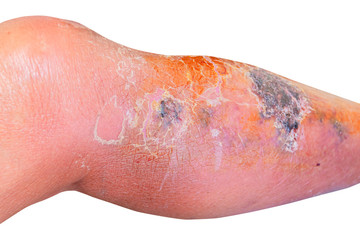 Erysipelas bacterial infection Under the skin leg aged people On  white background