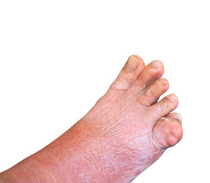 gout foot little finger in aged people Close up On white background
