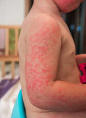 Allergies, pimples on the baby's skin. Food allergy.