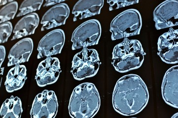 Magnetic resonance image scan of a man brain with a colloid cyst. MRI film of a human skull and brain tumor. Neurology background. Medicine, science.