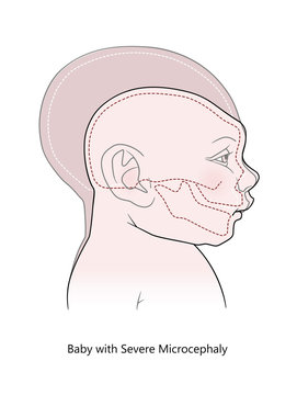 Comparative anatomical image of the head and skull of a newborn child with a normal cranium and severe microcephaly. Virus of Zika. Isolated on white background