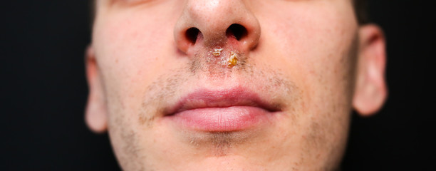 Obraz premium Wirus opryszczki pod nosem. Opryszczka po grypie. Zdjęcie medyczne. Leczenie chorób.