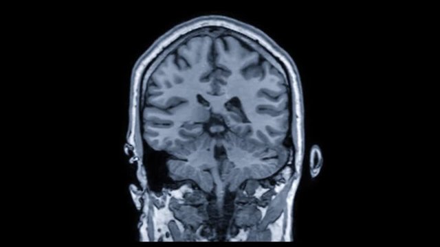 detailed medical coronal brain fMRI scan of healthy adult male back to front
