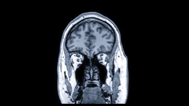 detailed medical coronal brain fMRI scan of healthy adult male front to back