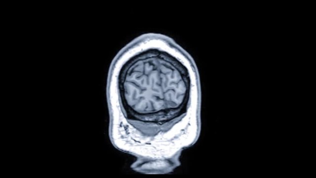 detailed medical coronal brain fMRI scan of healthy adult male back to front slow motion