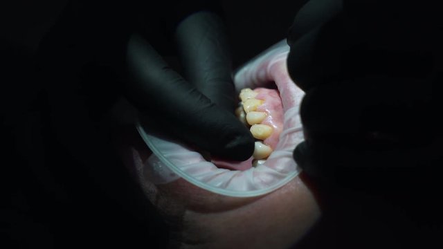 installation of veneers on the jaw closeup