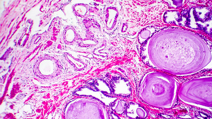 Histopathology of prostate gland hyperplasia, light micrograph, photo under microscope