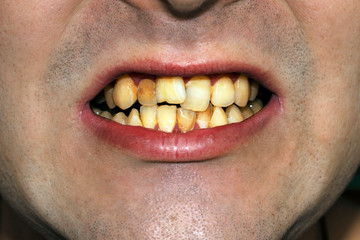 crooked, dirty, smoker's teeth with a wrong bite