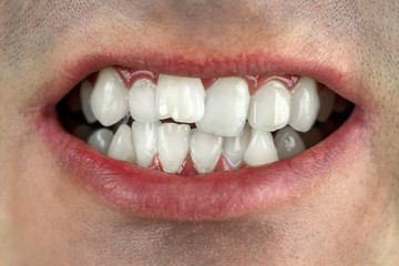 crooked teeth, wrong bite, close-up