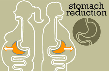 stomach reduction surgery