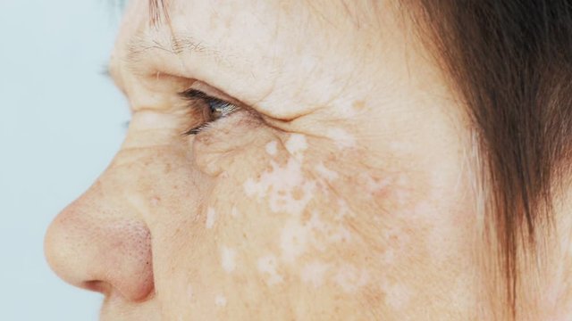 Portrait of an elderly woman with spots on the skin of the face. Close up.