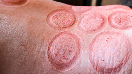 Hijama - the treatment of bloodletting. Red vacuum spots after hijama