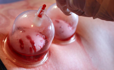 Hijama - the treatment of bloodletting. Attached vacuum cup. Blood fills in the cup.