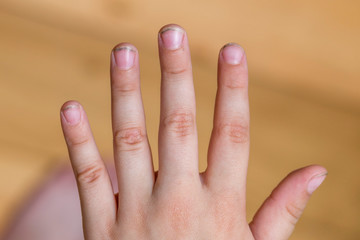 Dirty long nails have germs make sick. Dirt under the nails of a child. Hygiene children's hands