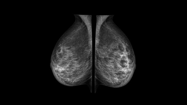 Close up of Mammogram X Ray Analysis. Mammography diagnostic to prevent breast cancer. 4k video