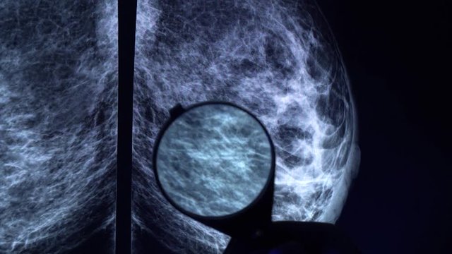 Doctor with magnifying glass checking mammogram x-ray. Mammography diagnostic to prevent breast cancer. 4k close up video