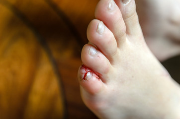 deep cut of the little finger on the leg, peeling of the nail and torn skin on the finger.