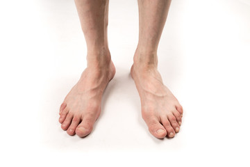 naked legs of a man with varicose veins on a white background