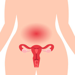 Gynecology. Medical illustration concept of healthy female reproductive system with the uterus and the ovaries. Abdominal pain during menstruation
