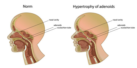 Norm and hypertrophy of adenoids. Location of adenoids.